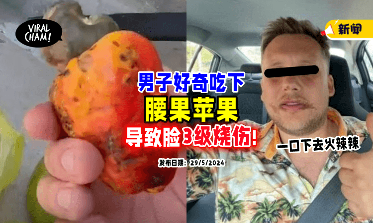 【没有Check清楚❗】男子尝鲜吃「腰果苹果🍎」一口咬下致脸部3度烧伤！