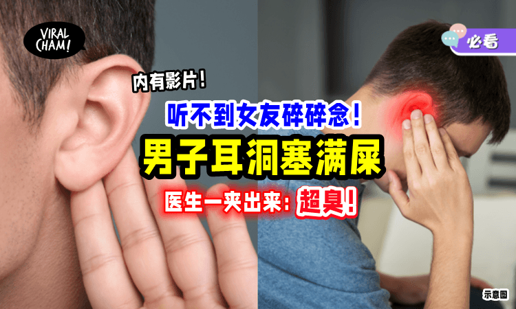 【听不到女友碎碎念❗️】25岁男子一查「耳洞被塞满满😱」医生警告：别用棉花棒掏耳屎！
