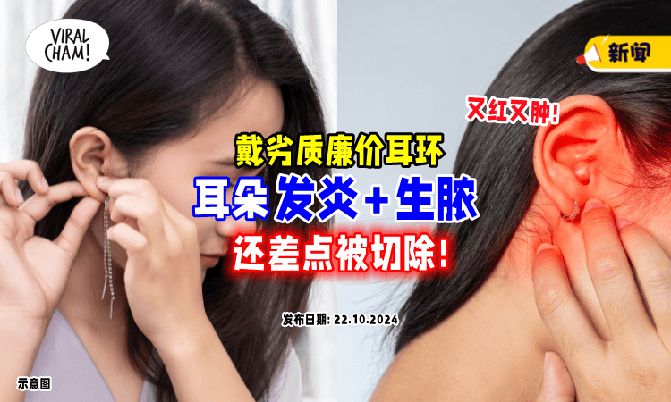 【爱美惹的祸❗】大马女子「戴廉价耳环」惨遭细菌感染⚡险些需要切除耳朵！