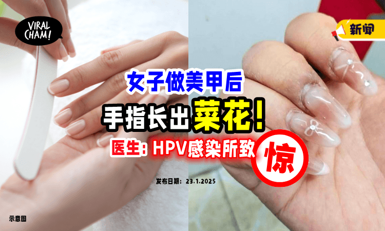 【手指长出菜花🥦】女子做美甲后「竟染上HPV病毒😱」医生劝：这1类人最好少做！