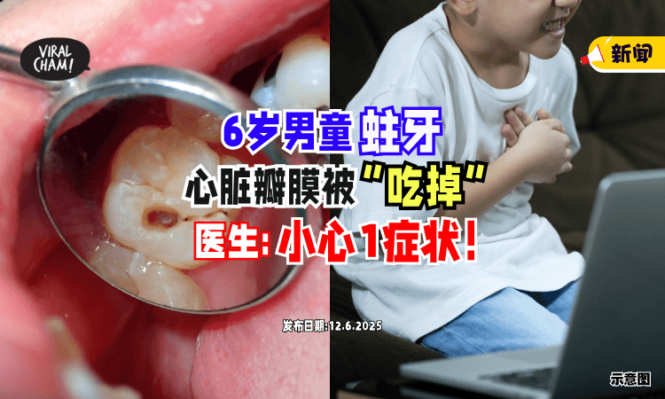 【1症状要警惕❗】6岁孩童蛀牙「心脏瓣膜被“吃掉”⚡」医师示警 : 严重或会夺命！