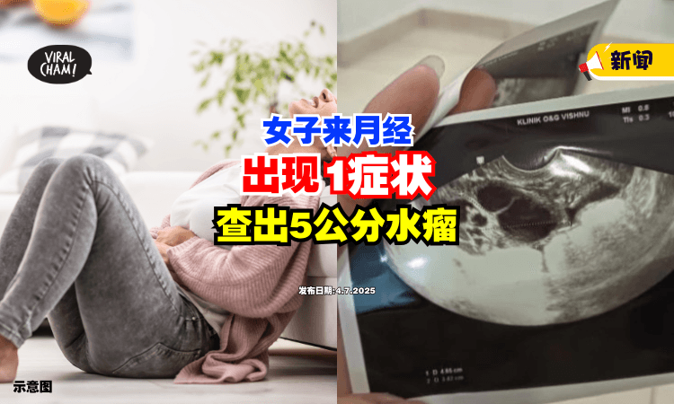 【长期没做子宫检查❗】女子月经出现「1症状」就医⚡ 竟查出5公分水瘤！