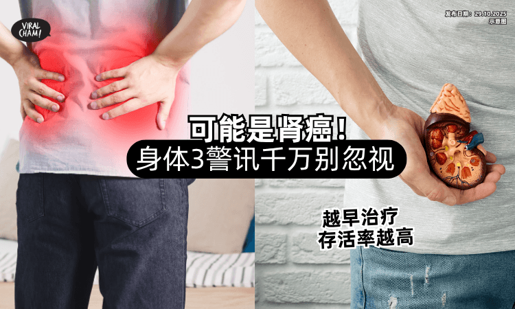 【许绍雄肾脏癌逝】医生提醒「3大警讯」千万别忽略⚡ 越早治疗存活率越高！