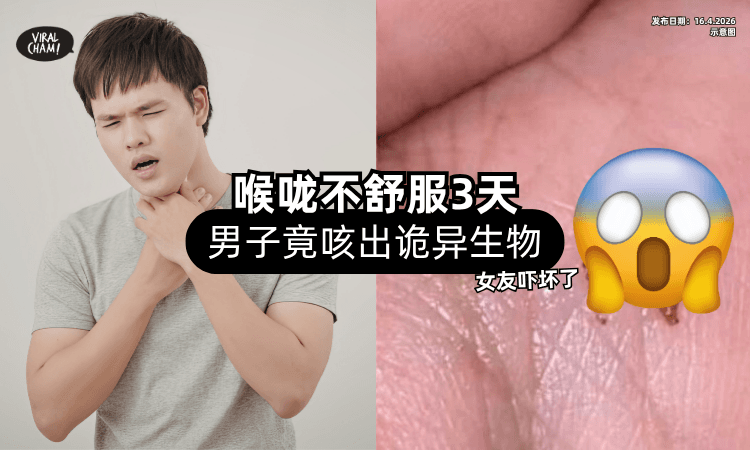 【真的有够吓人❗】喉咙不舒服3天⚡ 男子竟咳出「诡异生物」惊呆女友！