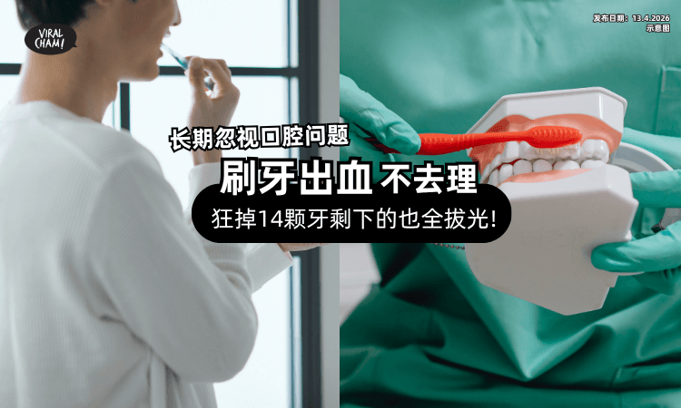【刷牙出血不去理】男子狂掉14颗牙⚡ 仅剩的也坏掉「全部拔光」❗