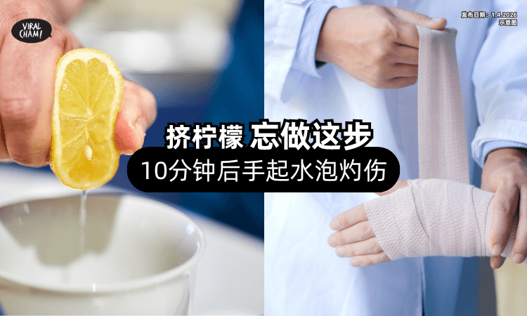 【少一个动作出事❗】女子挤了柠檬「忘做这步⚡」10分钟后手起水泡灼伤！