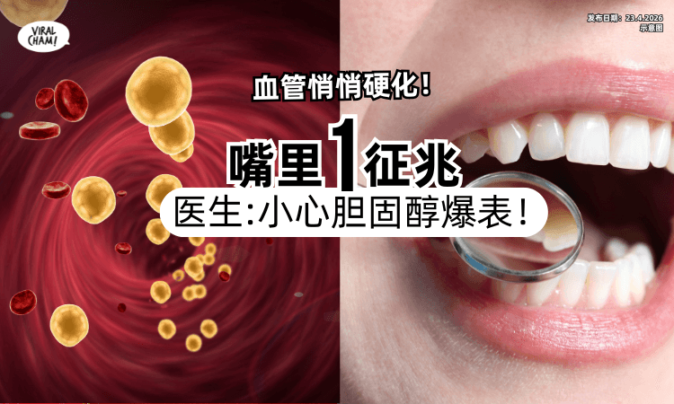 【Check一下❗】医生揭「嘴里1征兆」胆固醇爆表⚡ 35岁也难逃血管硬化！