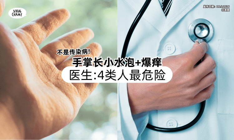 【不是传染病❗】手掌突然「疯长小水泡」还爆痒⚡ 医生：这4类人最危险！