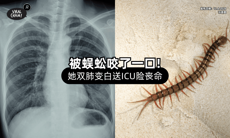 【别以为是小事❗】女大生「被蜈蚣咬一口」双肺全白⚡ 送ICU险丧命！