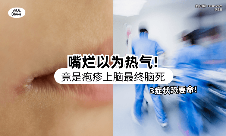 【以为太累发热气❗】30岁女嘴角生水泡没理会⚡ 结果「脑死」医警告：3症状别轻视！