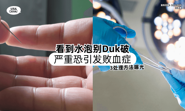 【看到水泡别Duk破❗】专业人士：严重「恐引发败血症⚡」3处理方法曝光！