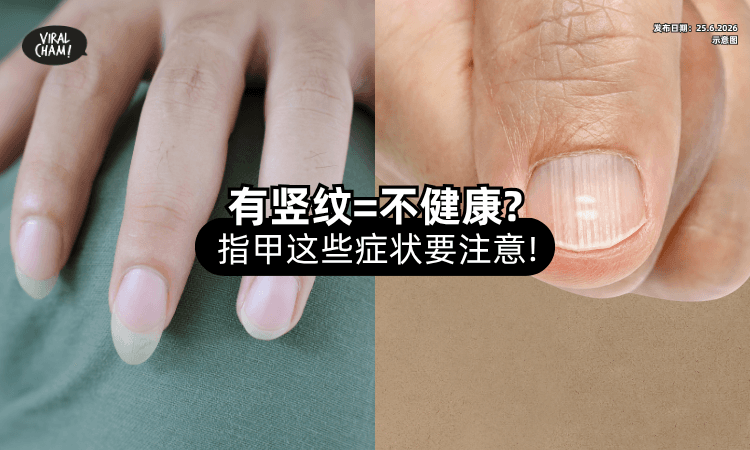 【看看你的手指❗】指甲「有竖纹」代表不健康❓ 专家这样解释！