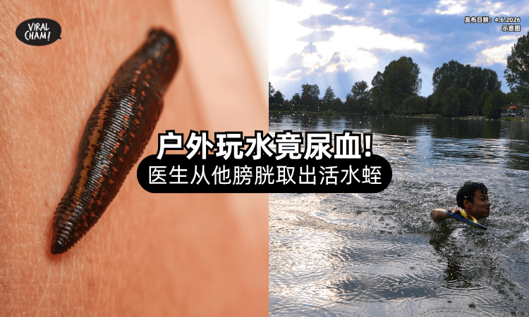 【户外湖泊玩水❗】男子回家后竟「尿血⚡」一查膀胱里藏着活水蛭！