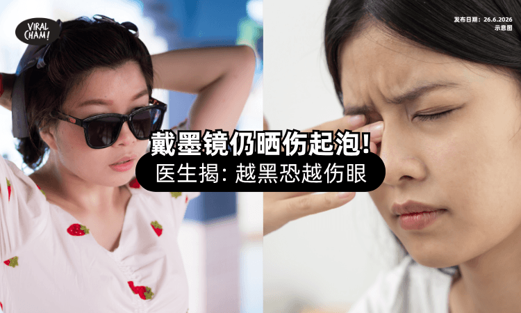 【越黑越伤眼❓】她戴墨镜双眼仍「晒伤+起泡⚡」医生提醒：选错更危险！
