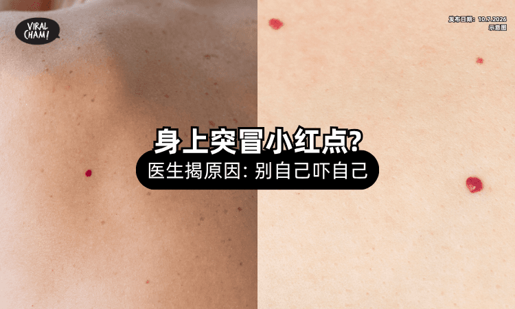 【别自己吓自己❗】身上突然冒「小红点」❓ 医生揭真正原因：不一定是癌症！
