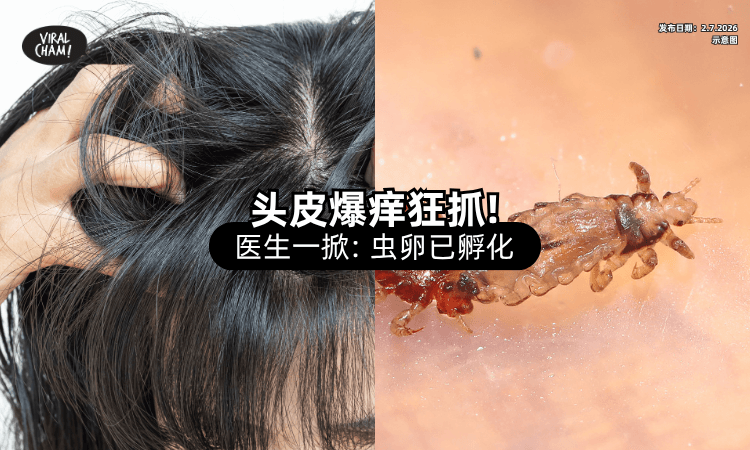 【以为是头皮屑❗】小学女童「头皮异常瘙痒」狂抓⚡ 医生掀开发现：虫卵已孵化