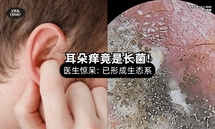 【耳朵奇痒难耐❗】耳镜一照惊见「满满一大片⚡」医生：已经成了生态系！