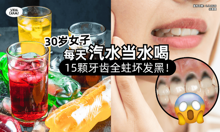 【一天至少1瓶❗】30岁女子为提神「汽水当水喝」短短1年半⚡15颗牙全部蛀坏！