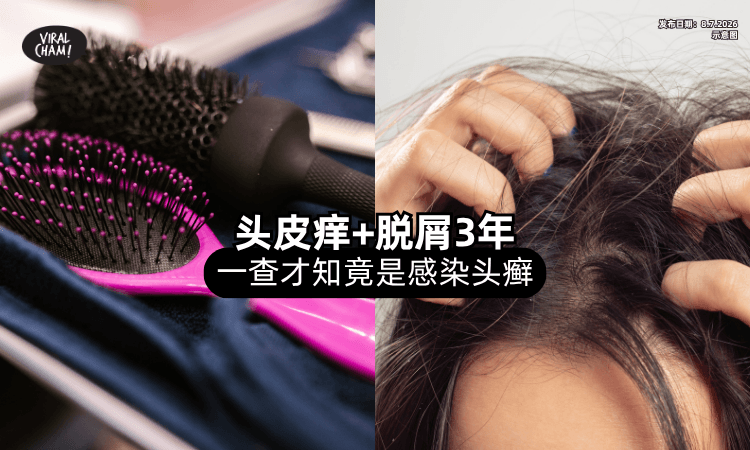 【常去Saloon注意❗】头皮发痒+脱屑3年⚡ 检查才知竟是「感染头癣」！