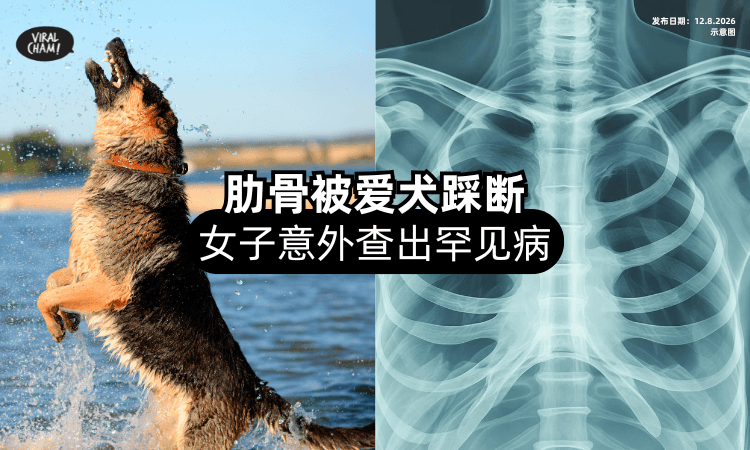 【因祸得福❗】肋骨被爱犬踩断⚡ 女子检查竟「发现罕见病」及时治疗！