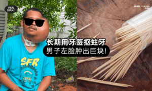 【痛不欲生❗】男子疑长期「用牙签抠蛀牙⚡」左脸长出巨大肿块！