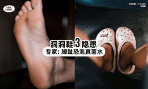 【小心变香港脚❗】洞洞鞋「3大隐患⚡」专家：脚趾恐泡真菌水！