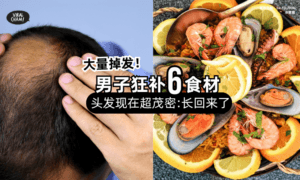 【秃头有救了❗️】37岁男子掉发「狂补6大食材⚡️」6周后头发超茂密“长回来了”！　