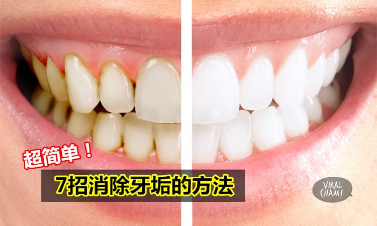 网名疯传！【7招消除牙垢的方法】免费又超简单的！