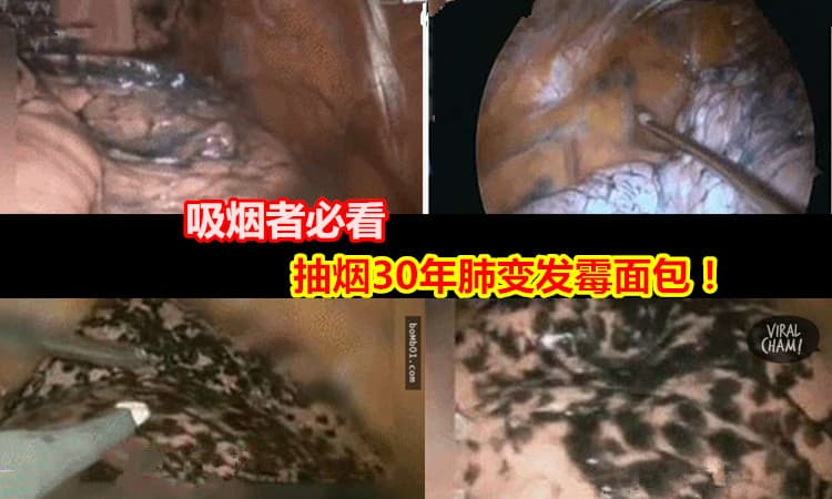 【抽烟30年 肺变发霉面包】看你还敢不敢抽烟！（内有影片）