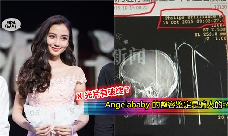 【Angelababy整容鑑定的X光片疑有破綻!】OMG 難道醫生收了錢騙人?