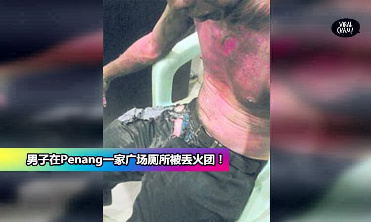 【发生在Penang】到购物广场上厕所被歹徒丢火团,导致灼伤60%更被抢走肩包