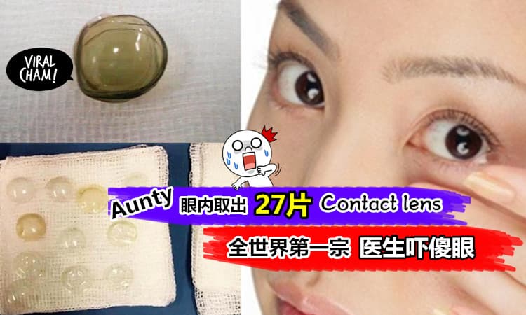 【眼睛内有27片隐形眼镜! 】吓到医生下巴都掉下来了～ 网友：这也太懒了吧！