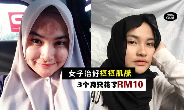 【最便宜的痘痘肌自救法!】曾经花千多块救脸失败，如今大马女子靠3个月从烂脸到痊愈，只用了RM10！