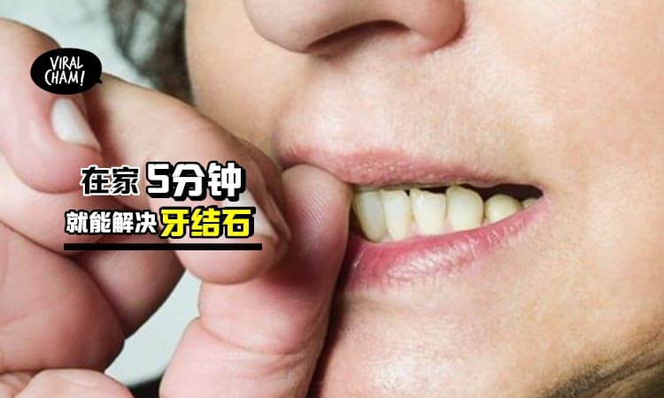【不用花钱去洗牙!!】教你4种超好用の方法, 让你5分钟就能解决牙结石！