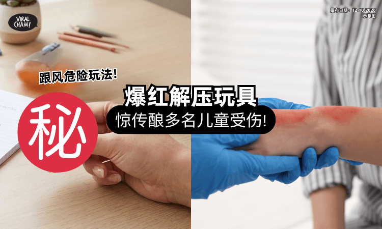 【家长要警惕❗】跟风危险玩法⚡ 全网爆红「解压玩具」酿多名儿童烧伤!